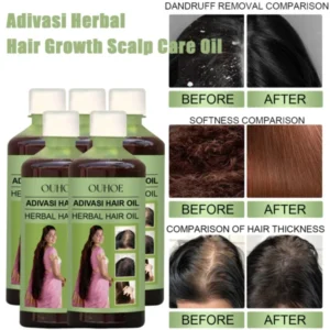 100ml Adivasi herbal hair growth oil with rosemary for scalp treatment and dandruff relief
